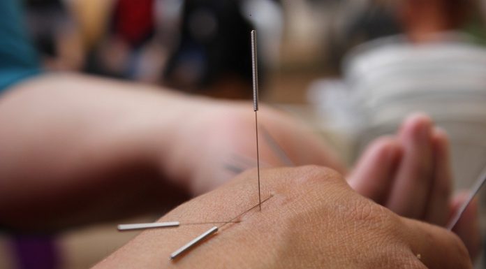 דיקור סיני לכאבים