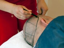 השתלות שיער וטיפולים מתקדמים – כל מה שצריך לדעת