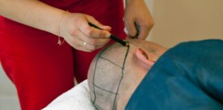 השתלות שיער וטיפולים מתקדמים – כל מה שצריך לדעת