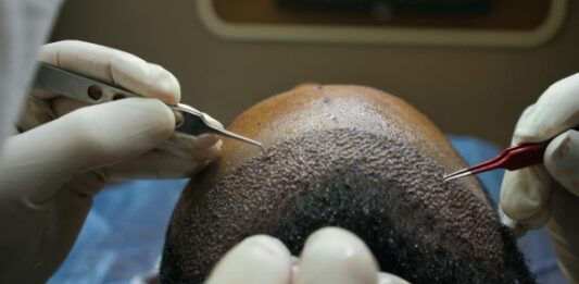 פתרונות מתקדמים להתקרחות ושיקום שיער